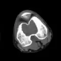 1. c. CT scan of chondroblastoma of thigh bone near knee (cross-section view)