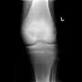 1. a. X-ray of chondroblastoma of thigh bone near knee