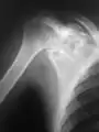 2. X-ray of chondroblastoma of shoulder blade