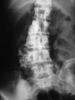 Chondrosarcoma spine