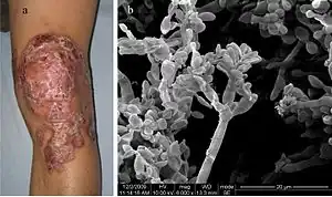 A 34-year-old man with a 12-year history of chromoblastomycosis and electron micrograph of his skin showing Fonsecaea pedrosoi spores.