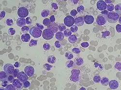 Peripheral blood (MGG stain): marked leukocytosis with granulocyte left shift