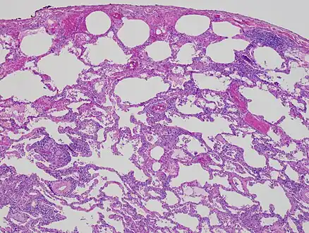 Low magnification view of the histology of chronic hypersensitivity pneumonitis. The interstitium is expanded by a chronic inflammatory infiltrate. Two multinucleated giant cells can be seen within the interstitium at left, and a plug of organizing pneumonia at bottom left.