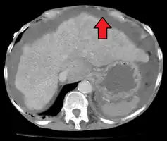 Liver cirrhosis with ascites