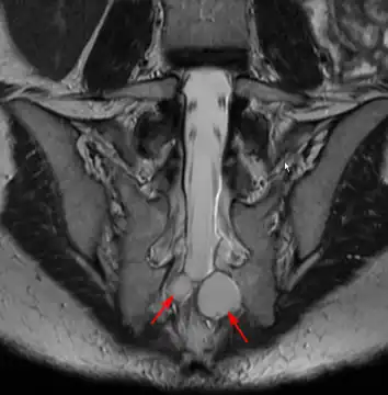 MRI image showing a Tarlov cyst