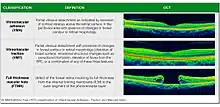 Classification of Vitreomacular Adhesion, Traction, and Macular Hole (IVTS 2013)