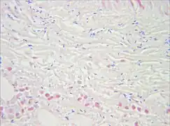 Gram stain of a muscle biopsy showing Gram-positive, rod-shaped, anaerobic, spore-forming bacteria in the infected muscle tissue: The result is highly compatible with an infection with C. perfringens.