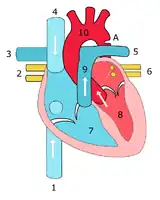 Sketch showing heart with coarctation of the aorta. A: Coarctation (narrowing) of the aorta. 1:Inferior vena cava, 2:Right pulmonary veins, 3: Right pulmonary artery, 4:Superior vena cava, 5:Left pulmonary artery, 6:Left pulmonary veins, 7:Right ventricle, 8:Left ventricle, 9:Pulmonary artery, 10:Aorta