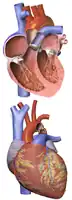 Illustration showing a heart with a coarctation of the aorta
