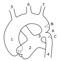 Schematic drawing of alternative locations of a coarctation of the aorta, relative to the ductus arteriosus. A: Ductal coarctation, B: Preductal coarctation, C: Postductal coarctation. 1: Aorta ascendens, 2: Arteria pulmonalis, 3: Ductus arteriosus, 4: Aorta descendens, 5: Truncus brachiocephalicus, 6: Arteria carotis communis sinistra, 7: Arteria subclavia sinistra