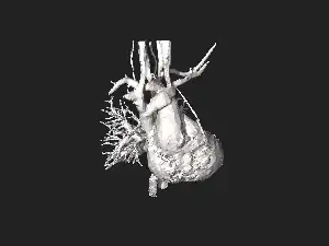 3D model of coarctation of aorta