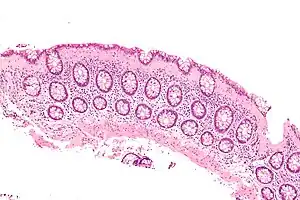 Micrograph of collagenous colitis