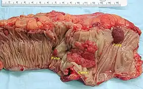 Gross appearance of a colectomy specimen containing two adenomatous polyps (the brownish oval tumors above the labels, attached to the normal beige lining by a stalk) and one invasive colorectal carcinoma (the crater-like, reddish, irregularly shaped tumor located above the label)