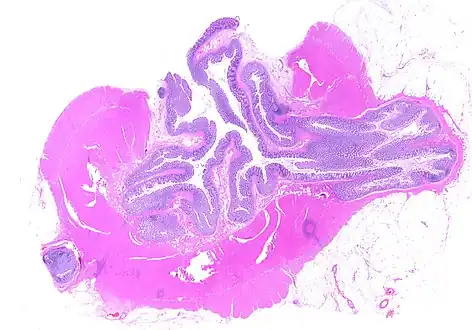 Whole slide of a transverse section of the left colon with diverticulosis