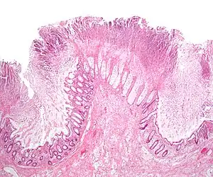 Micrograph of a colonic pseudomembrane, as may be seen in Clostridioides difficile colitis, a type of infectious colitis.