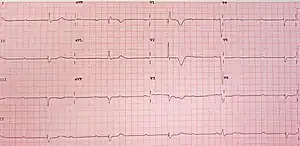 12-lead ECG showing complete heart block