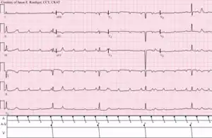 Atrial tachycardia with complete A-V block and resulting junctional escape