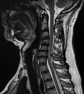 Compressive myelopathy at the C6-C7 level due to disc protrussion