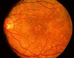 "Salt-and-pepper" retinopathy is characteristic of congenital rubella.