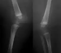 X-ray knees