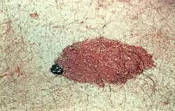 Congenital nevus. Note the variable coloration and slightly irregular border