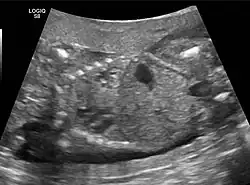 Congenital pulmonary airway malformation in a fetus, ultrasound at 19 weeks -sagittal. Stomach top right of image, heart displaced to bottom left of image (anatomically on the right side of fetus.)