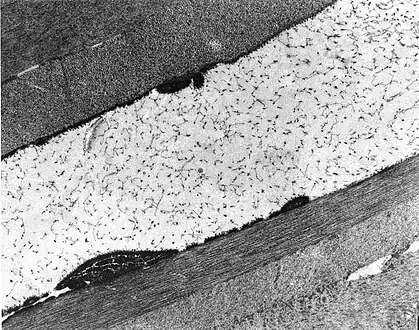 Congenital stromal dystrophy. Transmission electron microscopy of the corneal stroma showing normal collagen lamellae separated by abnormal randomly distributed collagen filaments in an electron-lucent extracellular matrix.