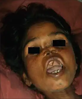 Saddle nose in congenital syphilis