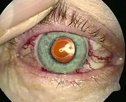 Dilated blood vessels in the eye in CCF