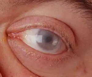 Corneal clouding in a 30-year-old male with MPS VI. Hurler syndrome and other MPS disorders may also present with corneal clouding