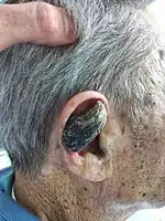 Cutaneous horn in right ear