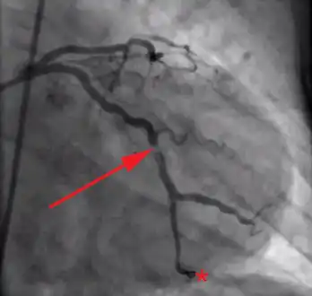 Coronary angiography of an MI patient
