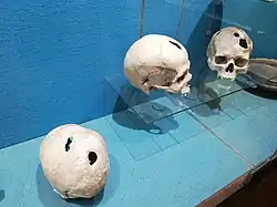 Skulls from the Bronze Age, exposed at the Musée archéologique de Saint-Raphaël (Archeological Museum of Saint-Raphaël), found in Comps-sur-Artuby (France). The subjects survived operations.