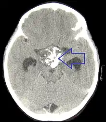CT scan showing a craniopharyngioma