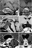Enhanced T1 weighted MRIs of craniopharyngiomas
