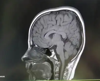 Brain MRI of individual with drug-induced aseptic meningitis.