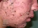 Crusted facial acne