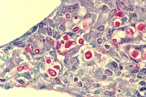C. neoformans seen in the lung of a patient with AIDS. Mucicarmine stain is used in this case, staining the inner capsule of the organism red.