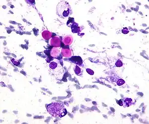 Field stain: thick cryptococcosis capsule