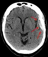 A subdural hematoma demonstrated by CT