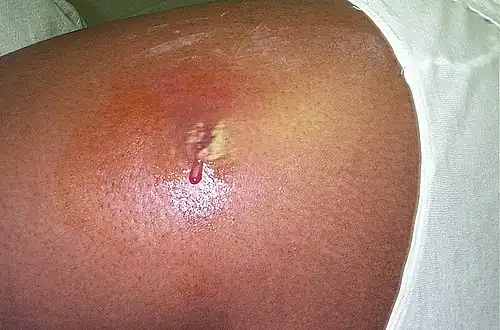 An abscess caused by opportunistic S. aureus bacteria.