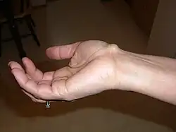 Cyst on right wrist
