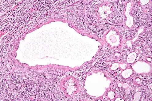 High magnification micrograph of a cystic nephroma showing the characteristic simple epithelium with hobnail morphology, and the ovarian-like stroma. H&E stain.