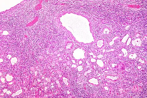Micrograph of a cystic nephroma. H&E stain.
