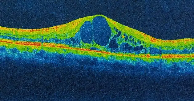 Cystoid macular edema (CME). There are intraretinal cystoid spaces