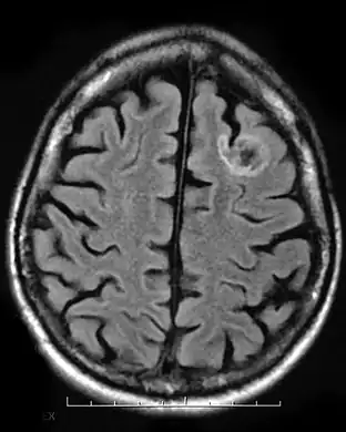 Dysembryoplastic neuroepithelial tumour, MRI FLAIR.