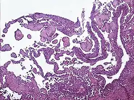 Low power photomicrograph of an endovascular papillary angioendothelioma showing papillae with hyalinized cores