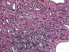 High power view showing a vascular tumor with cuboidal endothelium lining the vessels. Few entrapped seminiferous tubules are also noted (arrow).