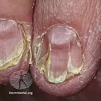 Malformed, weak nails with V-shaped chips, a common sign of Darier's disease