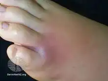 Spider bite-day 1